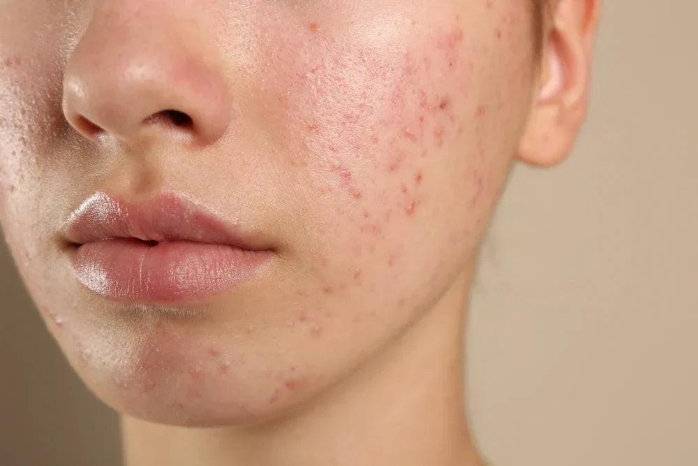 Stop the Stinging: How to Fix a Damaged Skin Barrier and Restore Your Glow