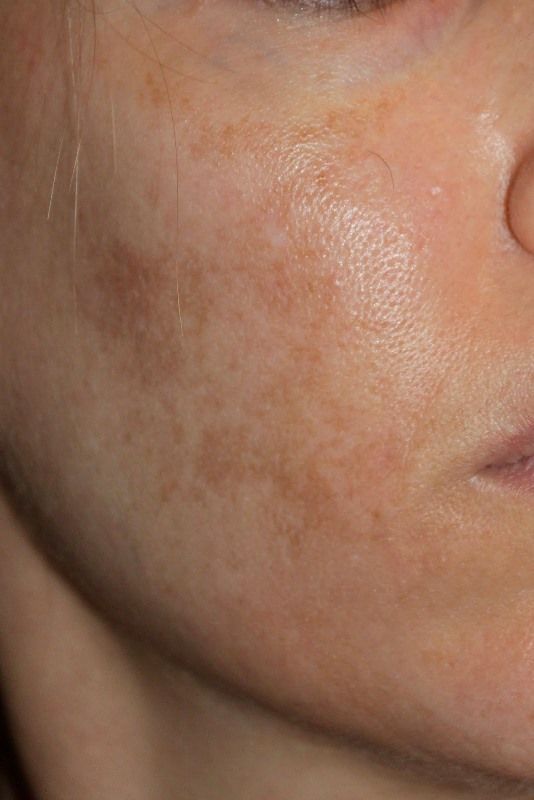 Skin Discoloration